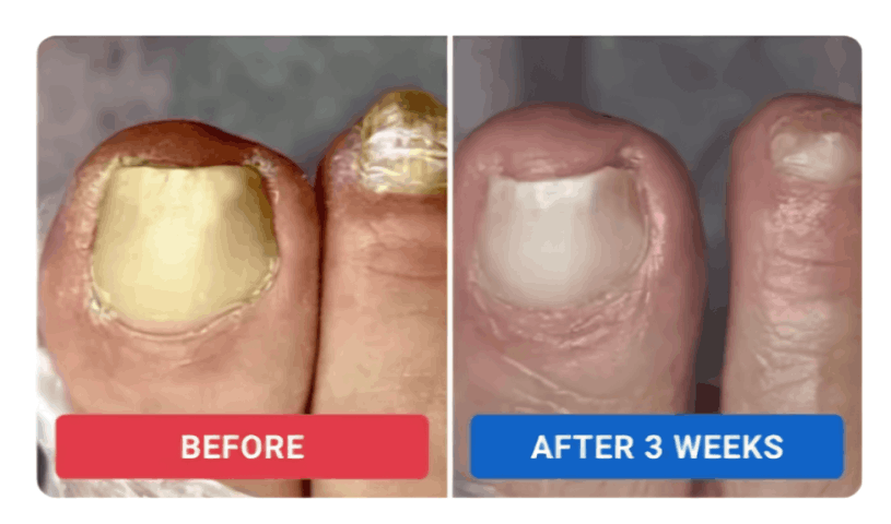 Orrivell Nail Fungus Pen review by Elena S. – Orrivell