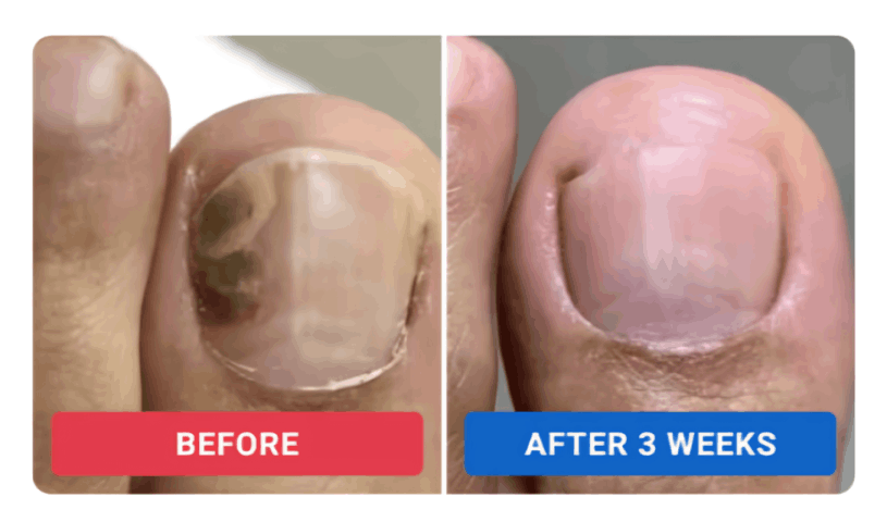 Orrivell Nail Fungus Pen review by Rachel M. – Orrivell